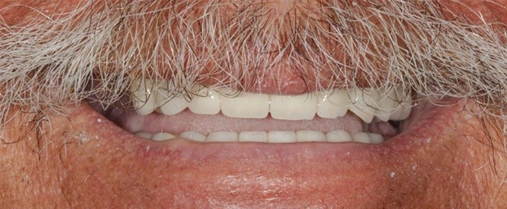From no upper teeth to a complete smile — after treatment