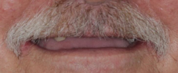 From no upper teeth to a complete smile — before treatment
