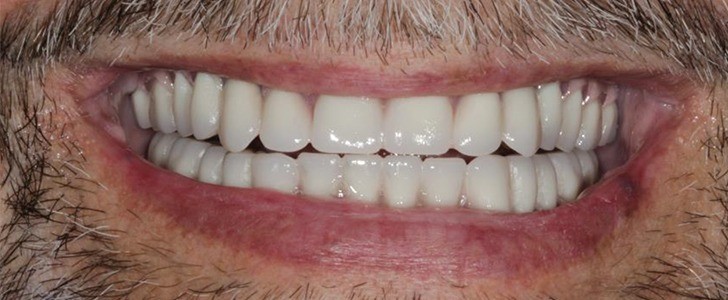 Completed dental restoration by Dr. Jonathan Berkowitz — case 1