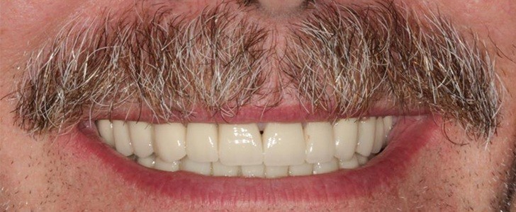 Completed dental restoration by Dr. Jonathan Berkowitz — case 2