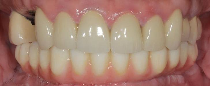 Completed dental restoration by Dr. Jonathan Berkowitz — case 3