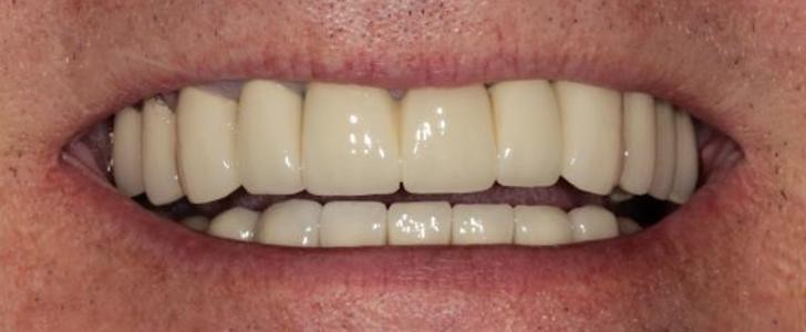 Completed dental restoration by Dr. Jonathan Berkowitz — case 4
