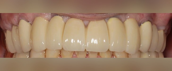 Completed dental restoration by Dr. Jonathan Berkowitz — case 5