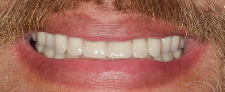 Completed dental restoration by Dr. Jonathan Berkowitz — case 6