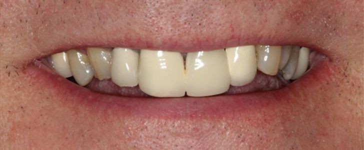 Completed dental restoration by Dr. Jonathan Berkowitz — case 7