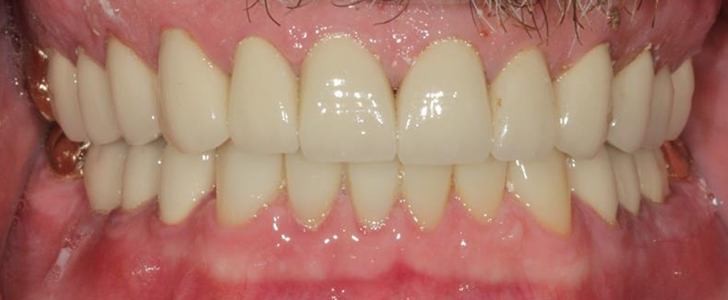Completed dental restoration by Dr. Jonathan Berkowitz — case 8